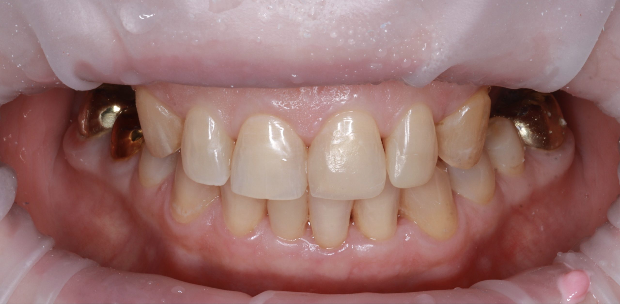 Лечение кариеса и реставрации зубов