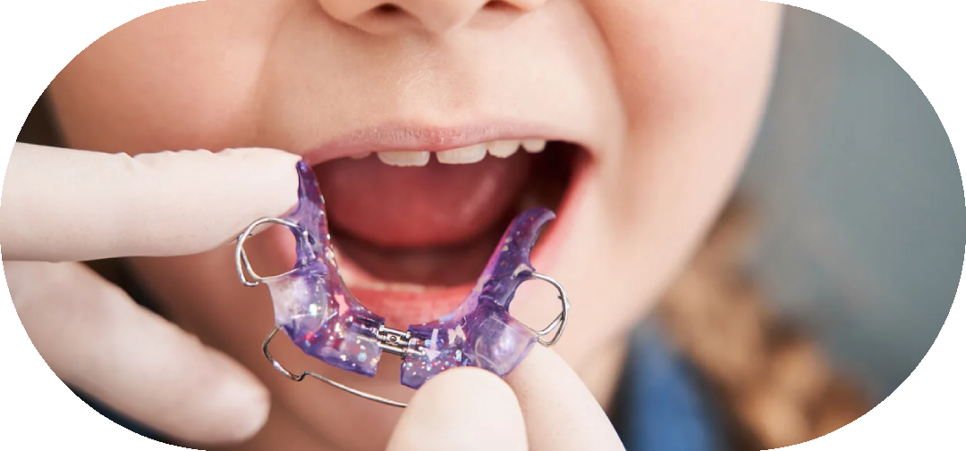 Детские ортодонтические пластины